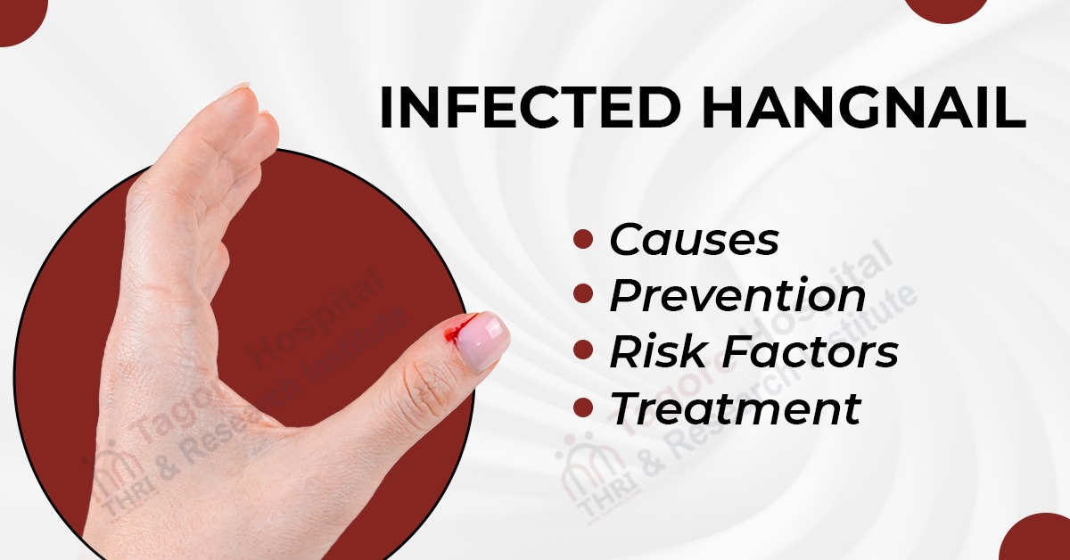 Infected Hangnail: Causes, Prevention, Risk Factors, and Treatment