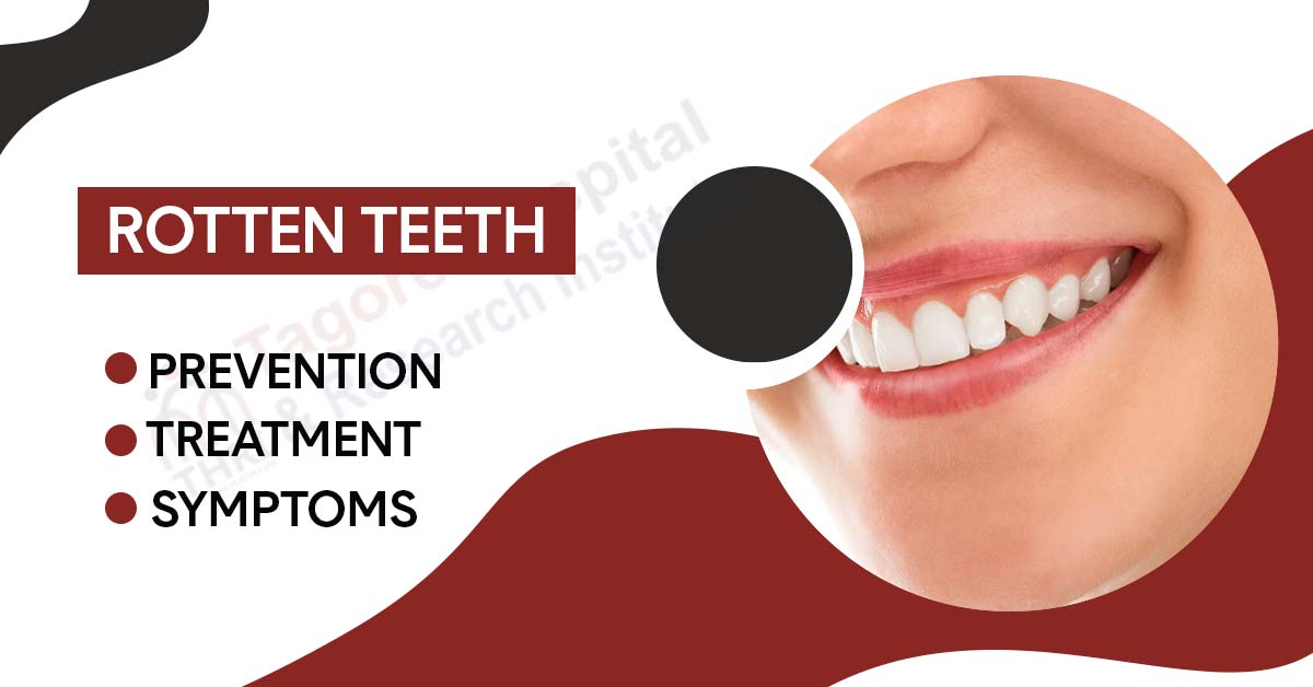 Rotten Teeth:  Symptoms, Prevention, and Treatment