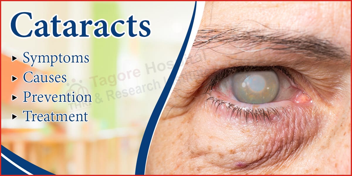 Cataracts - Symptoms, Causes, Prevention and Treatment