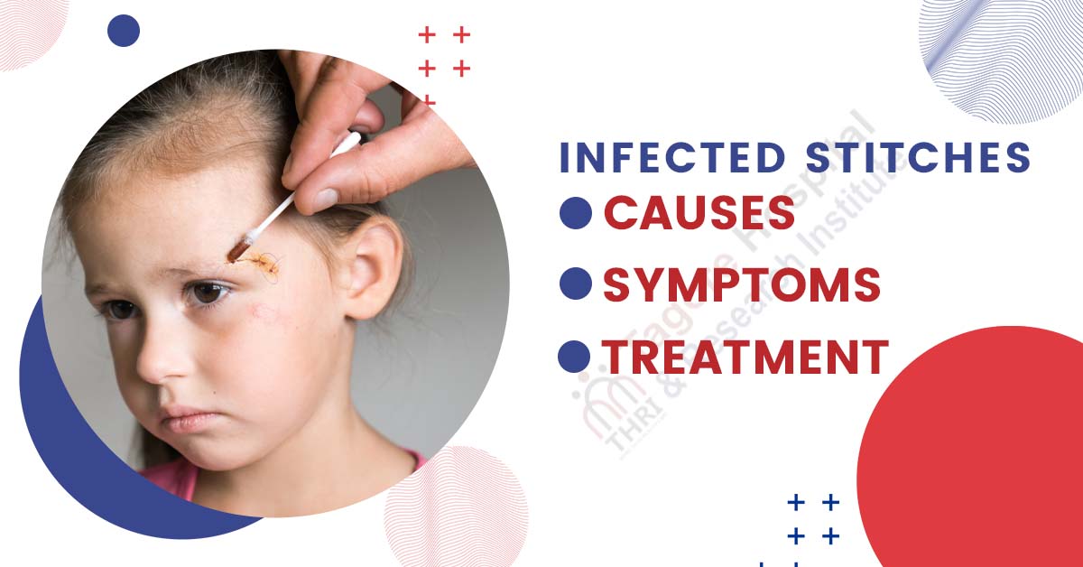 Infected Stitches: Symptoms, Causes, and Treatment